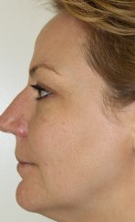 Vampire Facial 7 - After Treatment